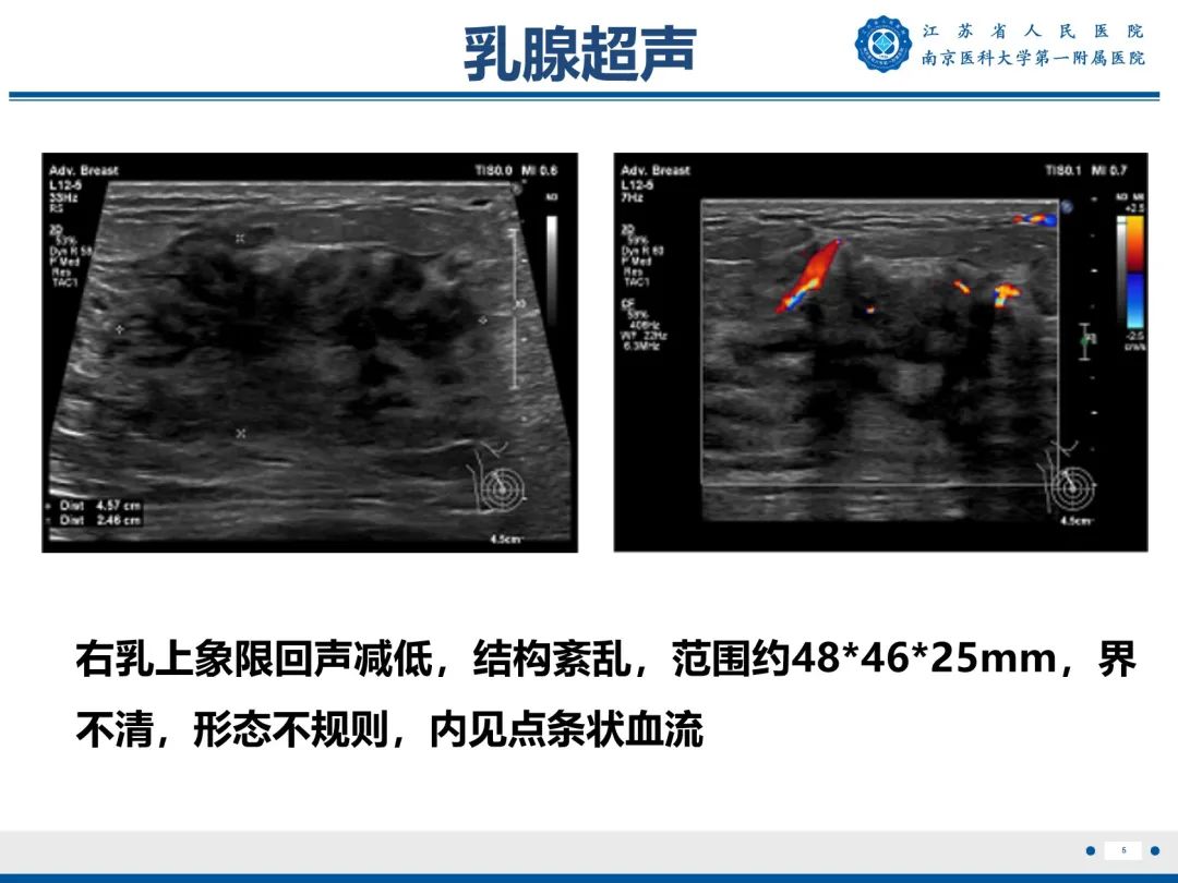 【PPT】导管原位癌-6