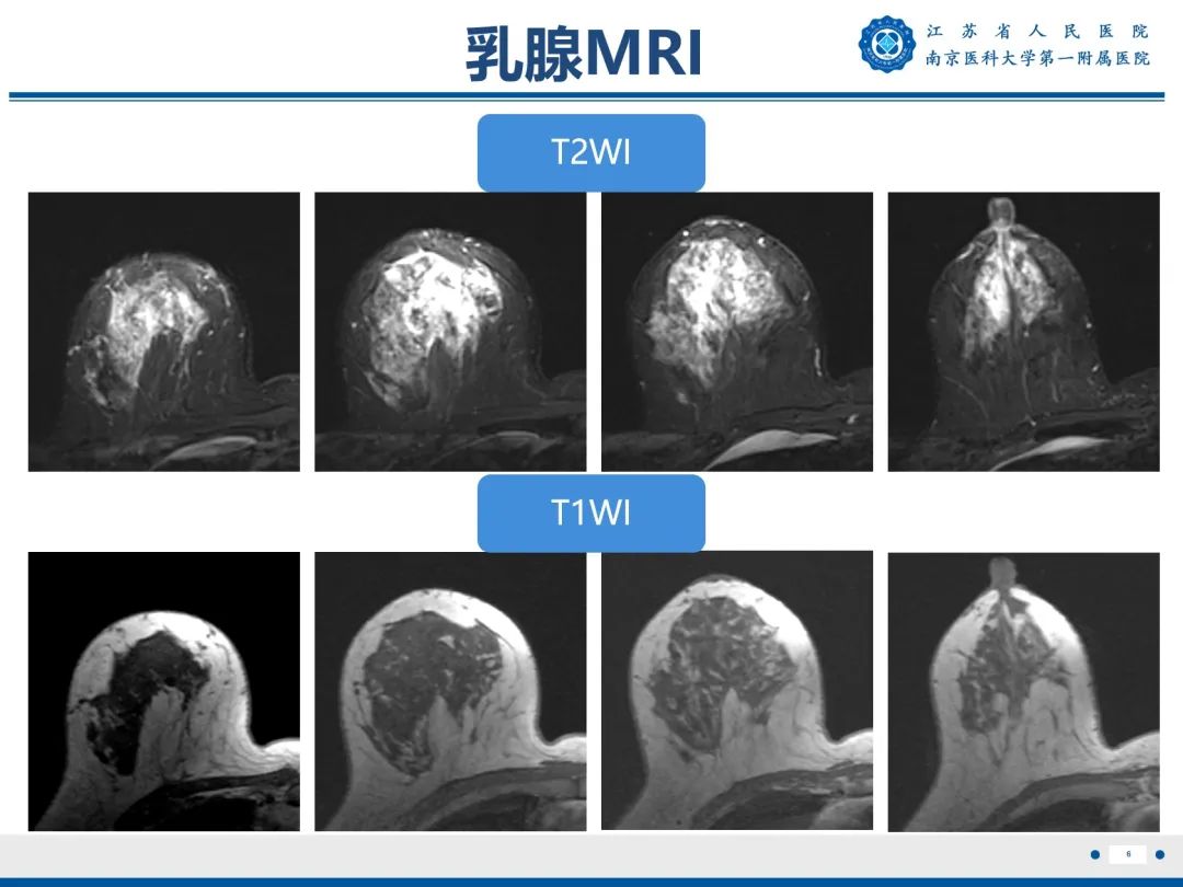 【PPT】导管原位癌-7