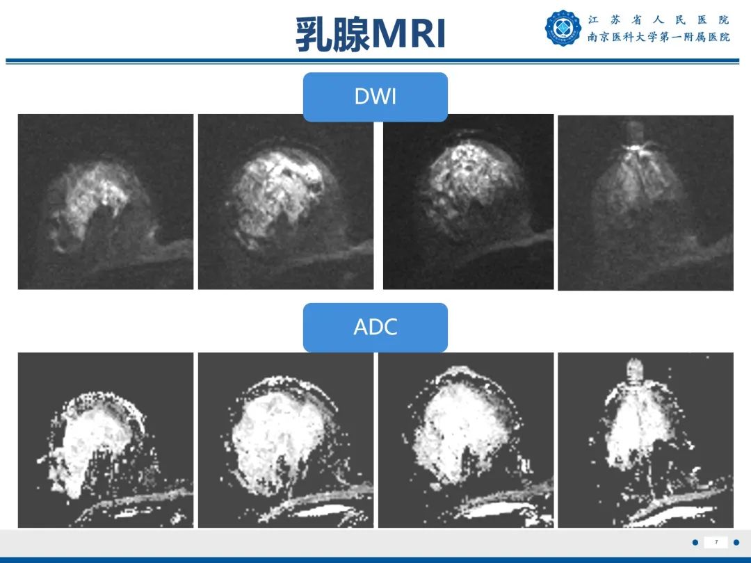【PPT】导管原位癌-8