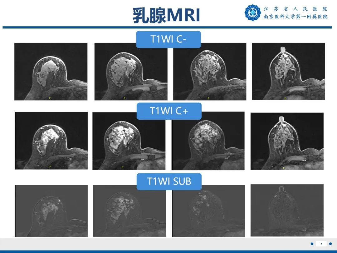 【PPT】导管原位癌-9
