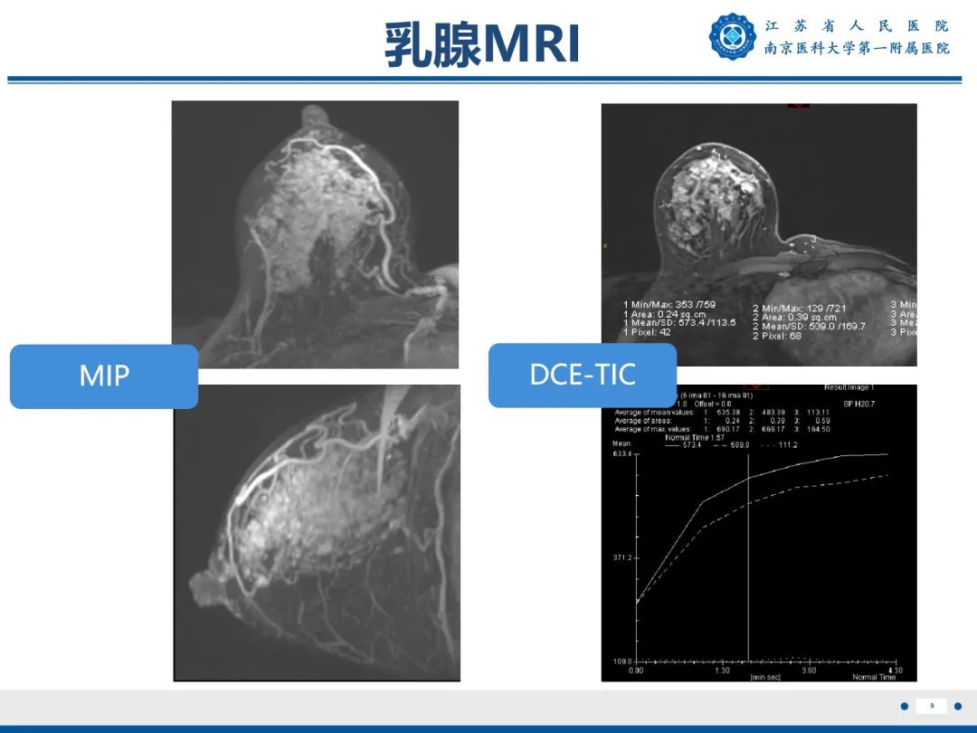 【PPT】导管原位癌-10