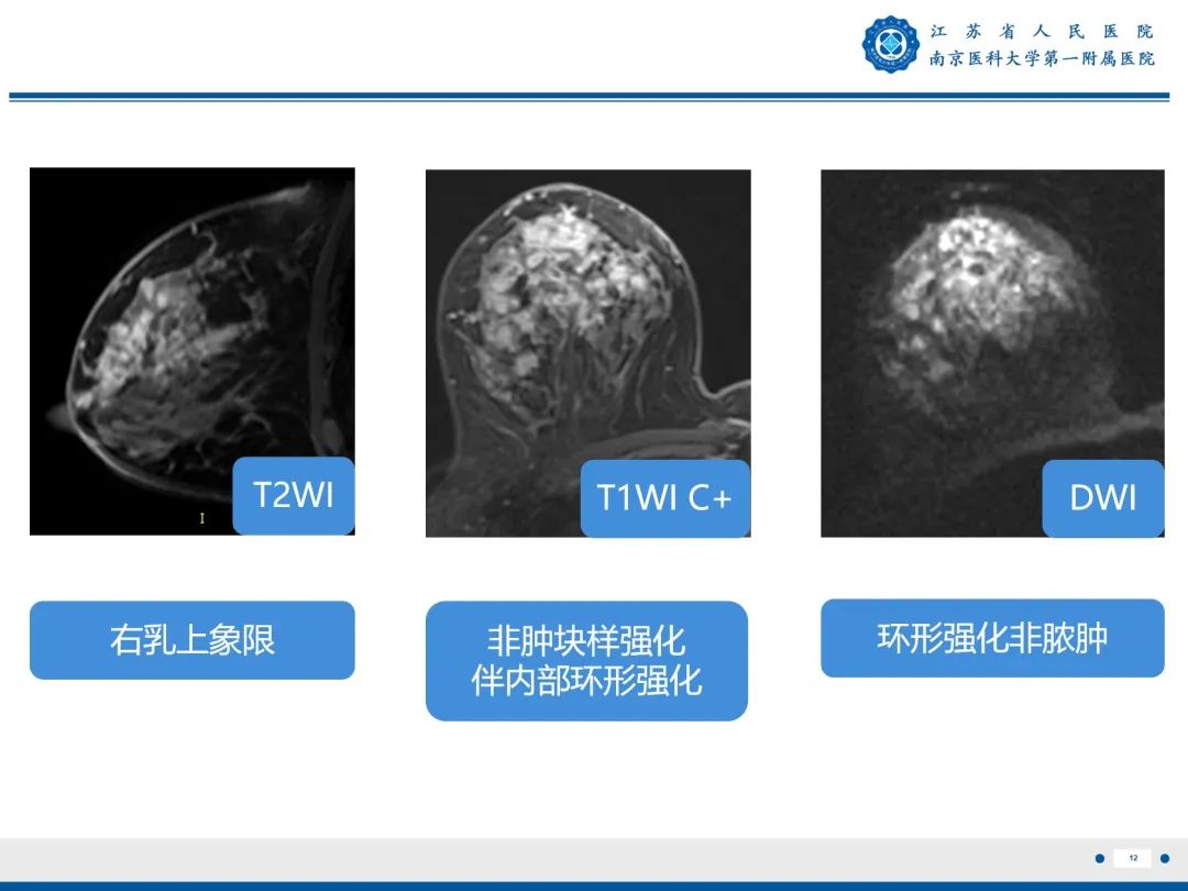 【PPT】导管原位癌-13