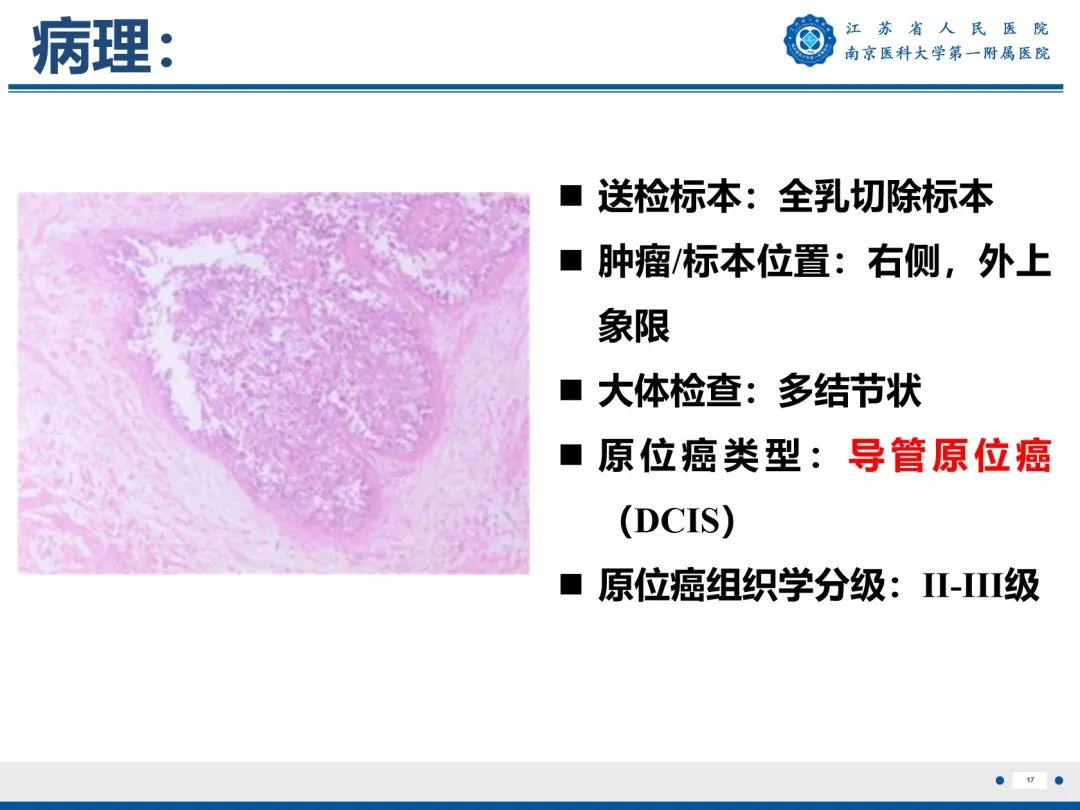 【PPT】导管原位癌-18