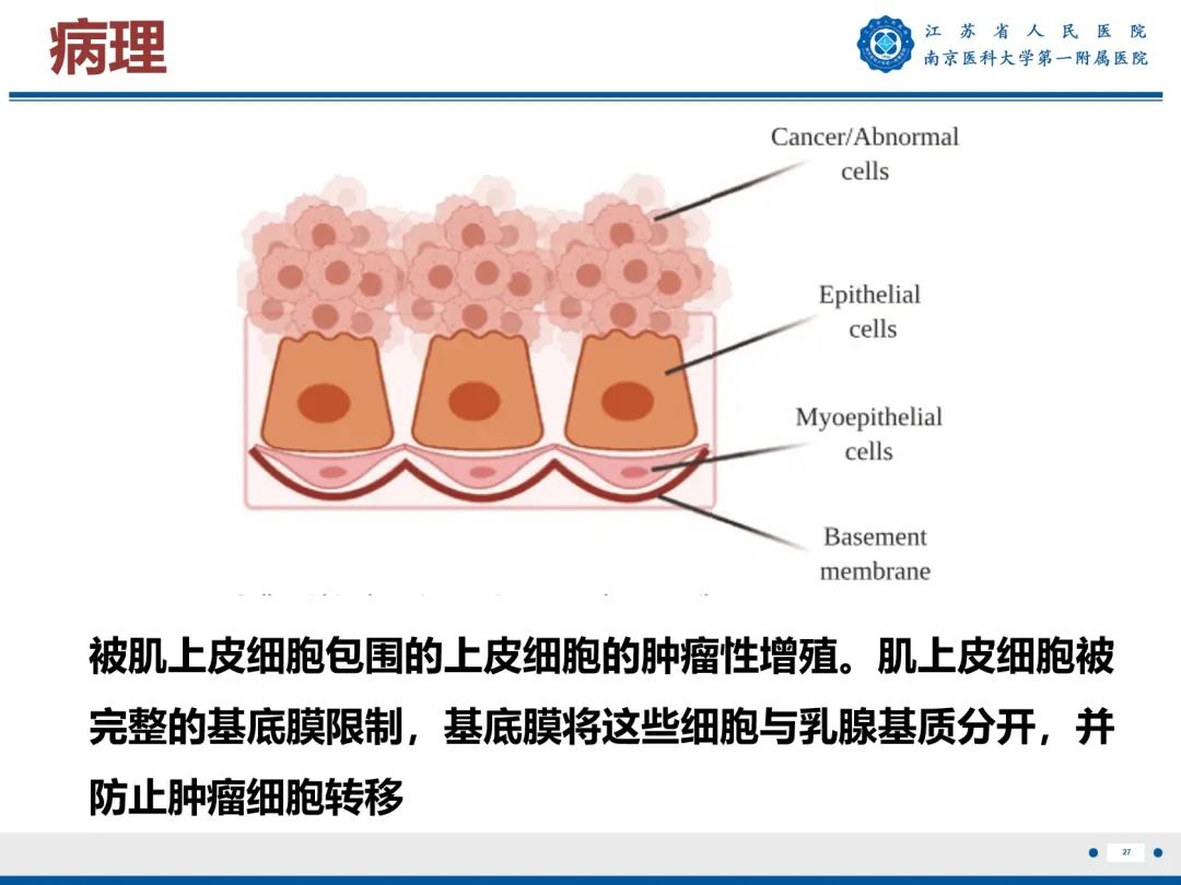 【PPT】导管原位癌-28