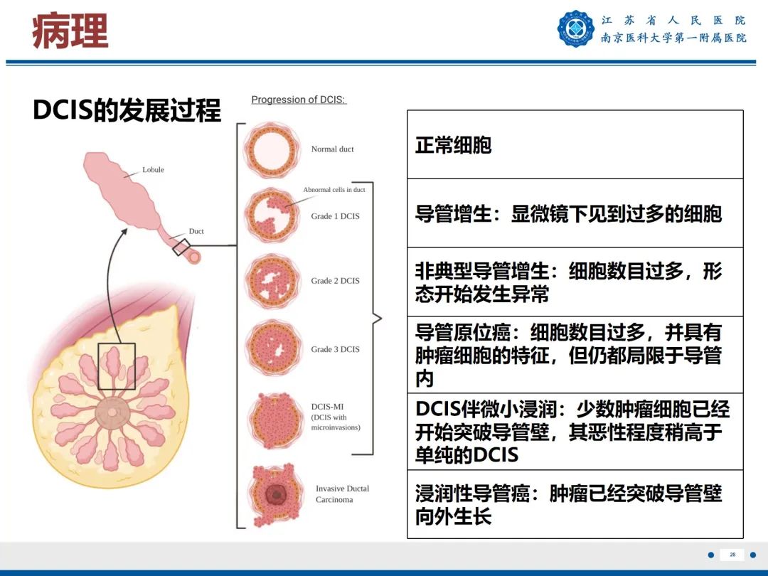 【PPT】导管原位癌-29