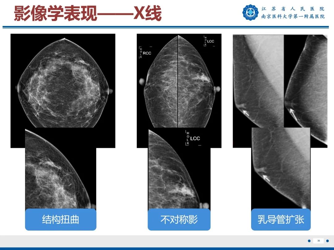 【PPT】导管原位癌-36