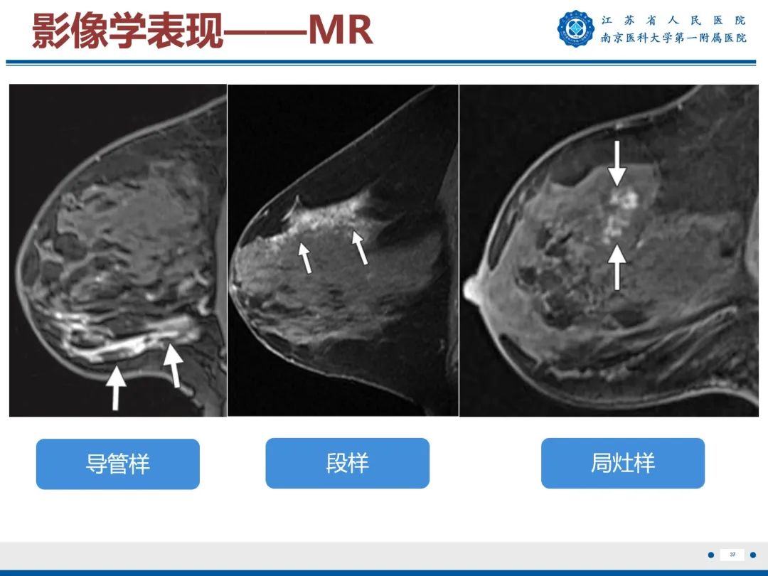 【PPT】导管原位癌-38
