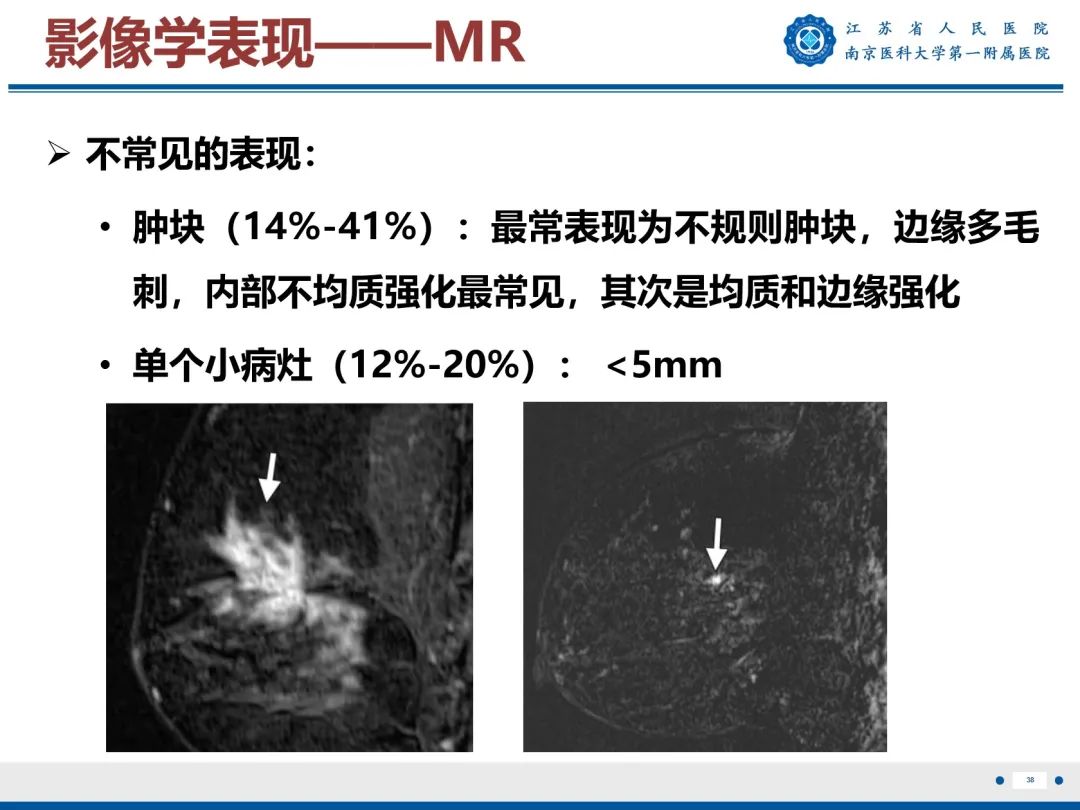 【PPT】导管原位癌-39