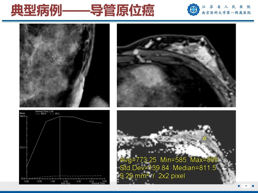 【PPT】导管原位癌-41