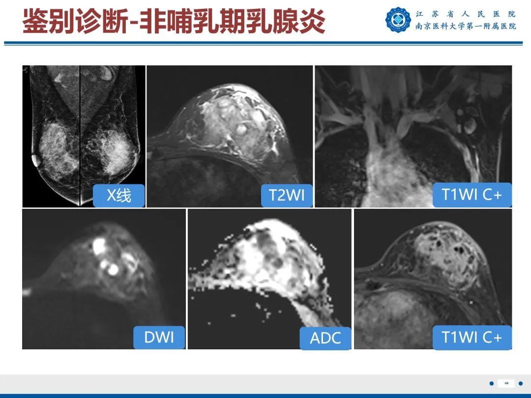 【PPT】导管原位癌-45