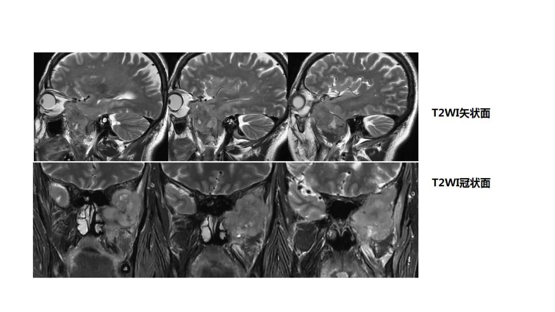 【病例】咬肌间隙肌纤维母细胞肉瘤1例MR诊断与鉴别-4