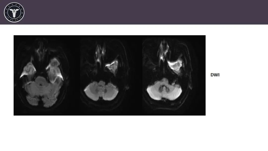 【病例】咬肌间隙肌纤维母细胞肉瘤1例MR诊断与鉴别-5