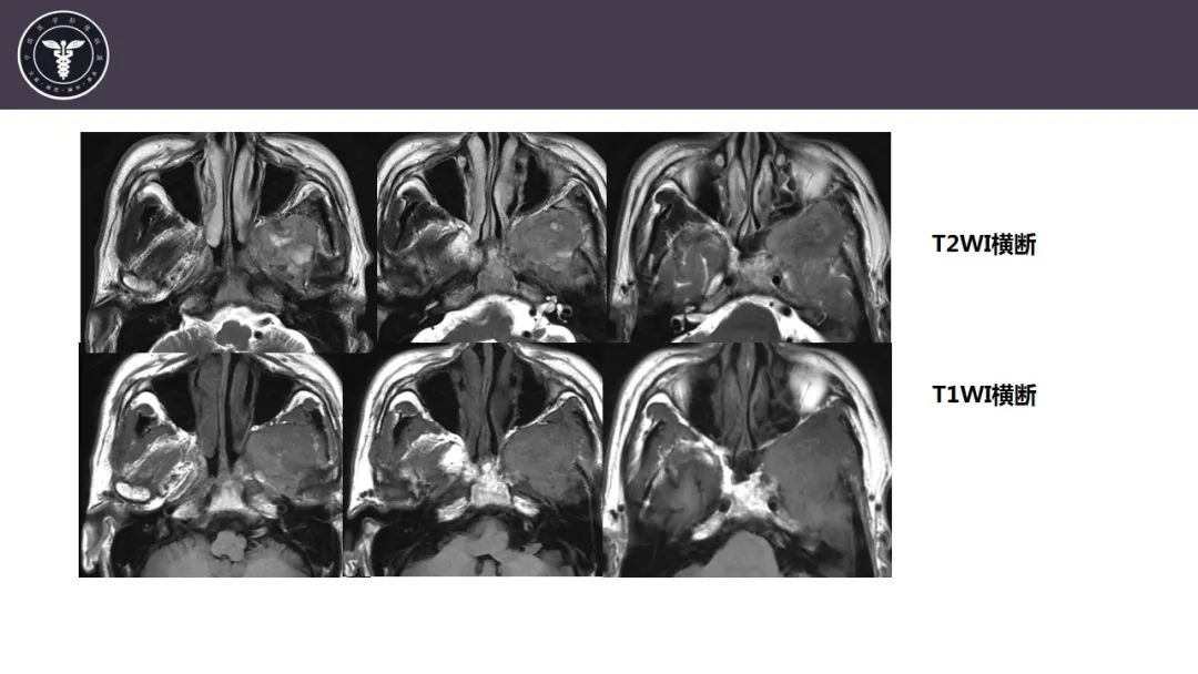 【病例】咬肌间隙肌纤维母细胞肉瘤1例MR诊断与鉴别-3