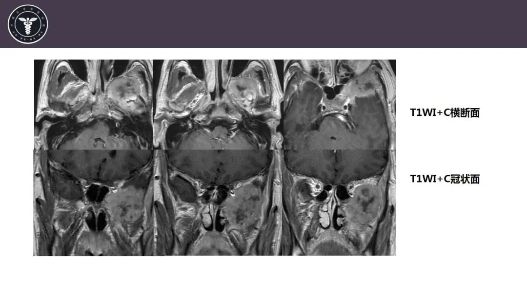 【病例】咬肌间隙肌纤维母细胞肉瘤1例MR诊断与鉴别-6