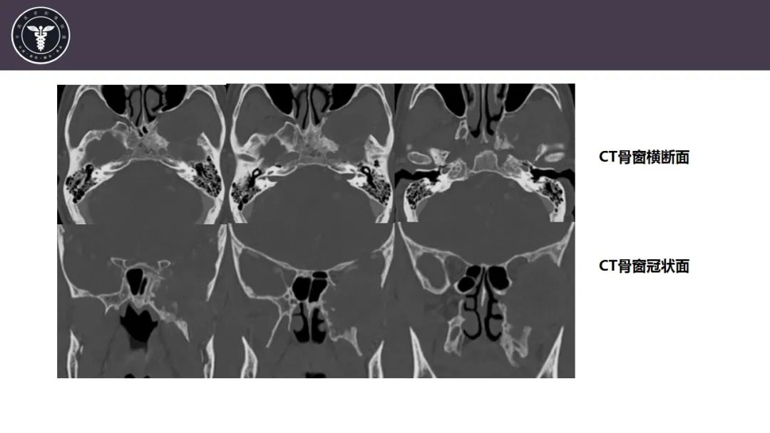 【病例】咬肌间隙肌纤维母细胞肉瘤1例MR诊断与鉴别-7