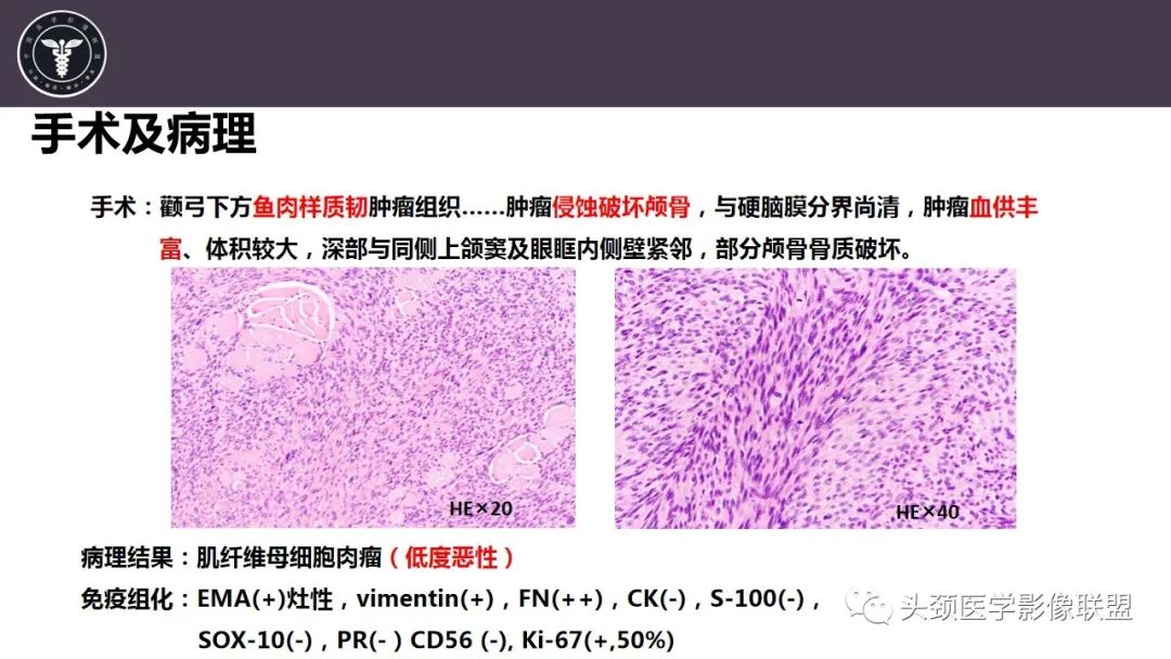 【病例】咬肌间隙肌纤维母细胞肉瘤1例MR诊断与鉴别-9