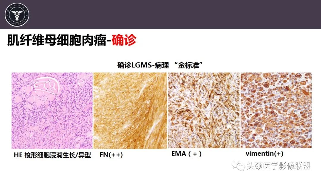 【病例】咬肌间隙肌纤维母细胞肉瘤1例MR诊断与鉴别-13