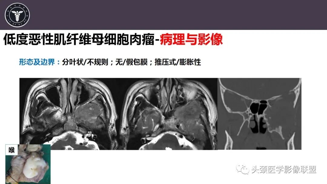 【病例】咬肌间隙肌纤维母细胞肉瘤1例MR诊断与鉴别-14