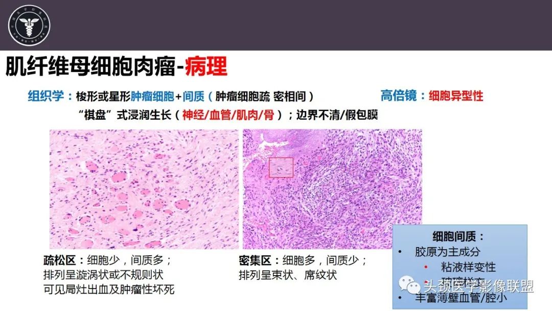 【病例】咬肌间隙肌纤维母细胞肉瘤1例MR诊断与鉴别-15
