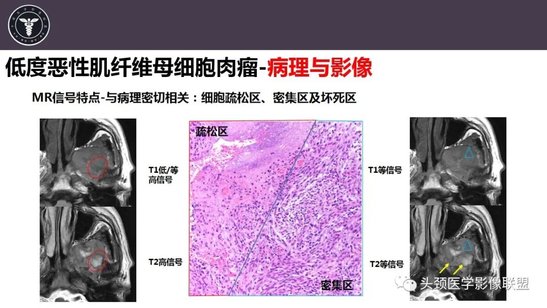 【病例】咬肌间隙肌纤维母细胞肉瘤1例MR诊断与鉴别-16