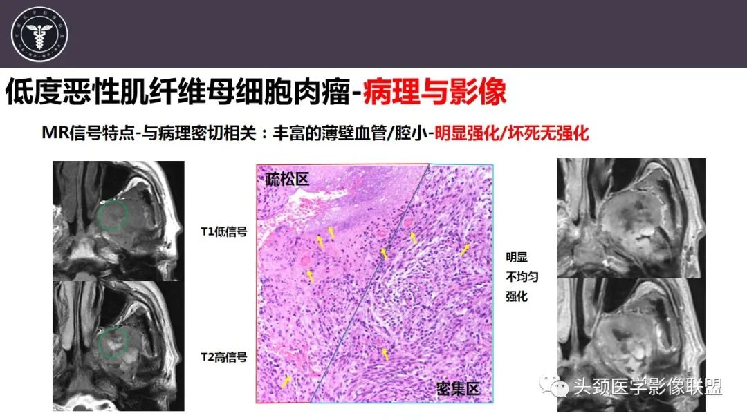 【病例】咬肌间隙肌纤维母细胞肉瘤1例MR诊断与鉴别-17