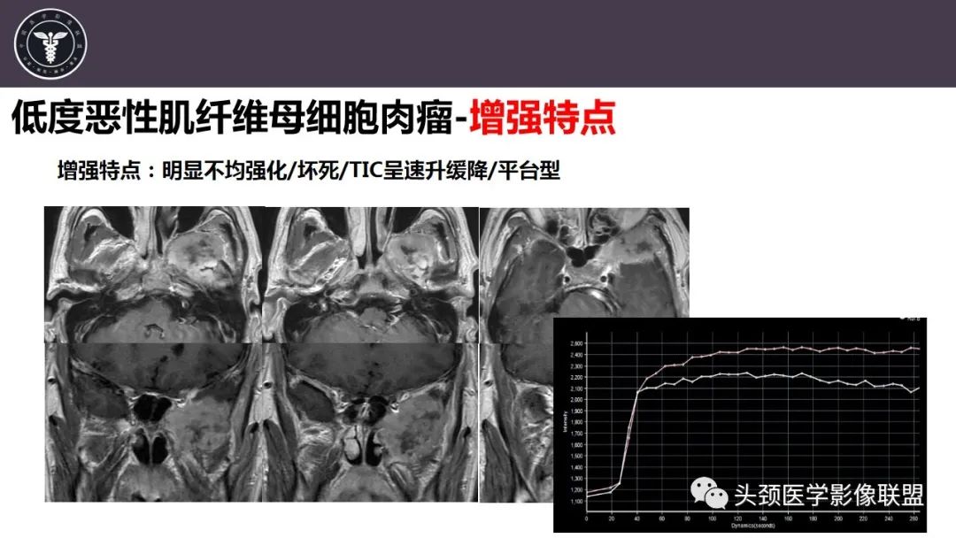 【病例】咬肌间隙肌纤维母细胞肉瘤1例MR诊断与鉴别-18