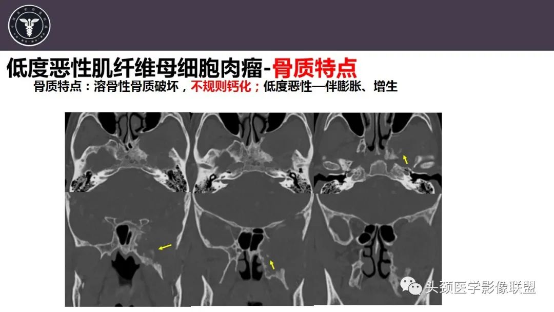 【病例】咬肌间隙肌纤维母细胞肉瘤1例MR诊断与鉴别-19