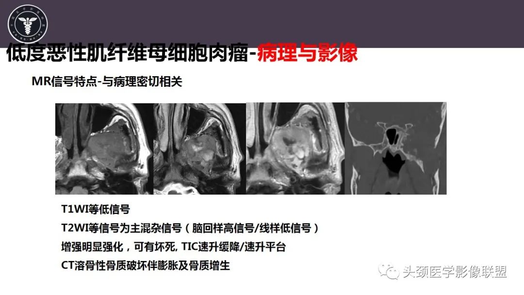 【病例】咬肌间隙肌纤维母细胞肉瘤1例MR诊断与鉴别-20
