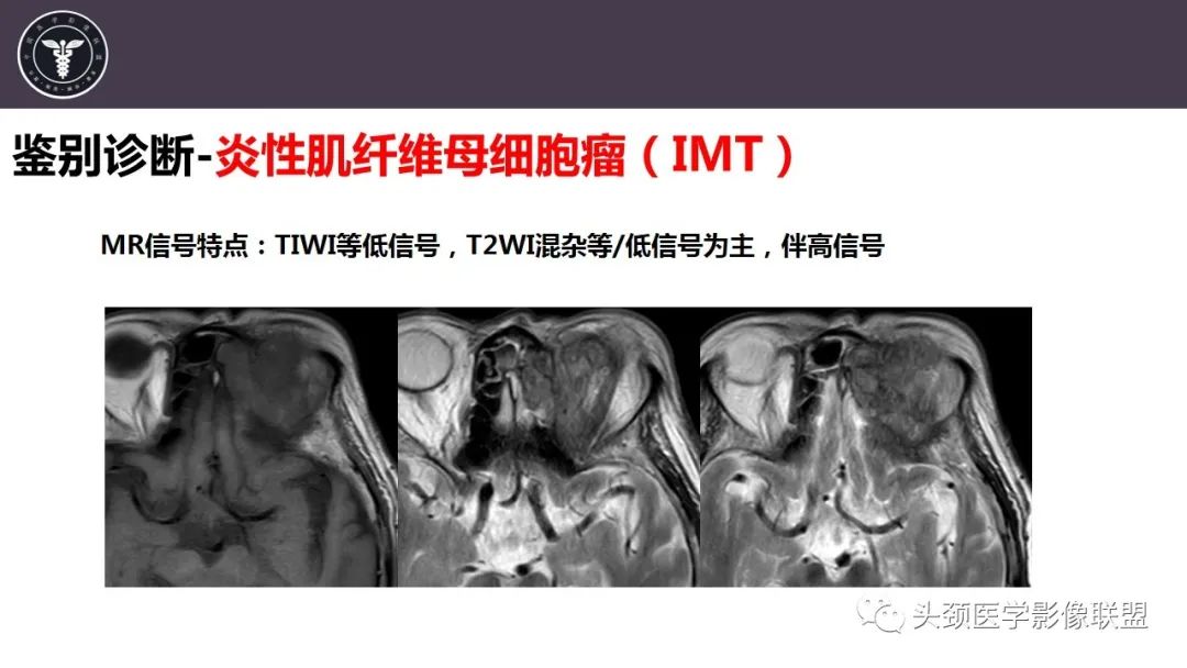 【病例】咬肌间隙肌纤维母细胞肉瘤1例MR诊断与鉴别-23