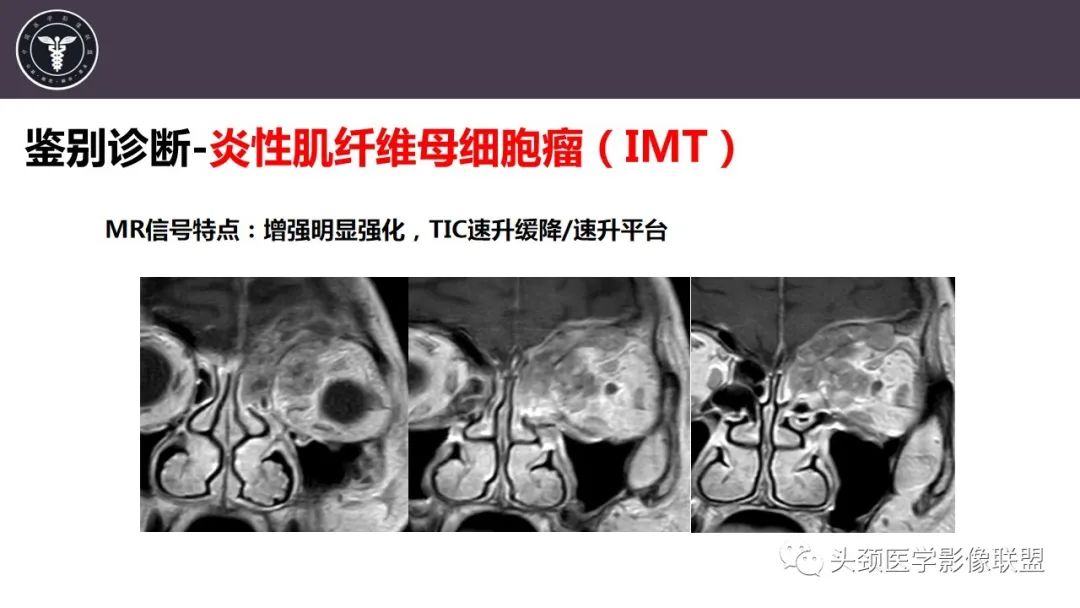 【病例】咬肌间隙肌纤维母细胞肉瘤1例MR诊断与鉴别-24