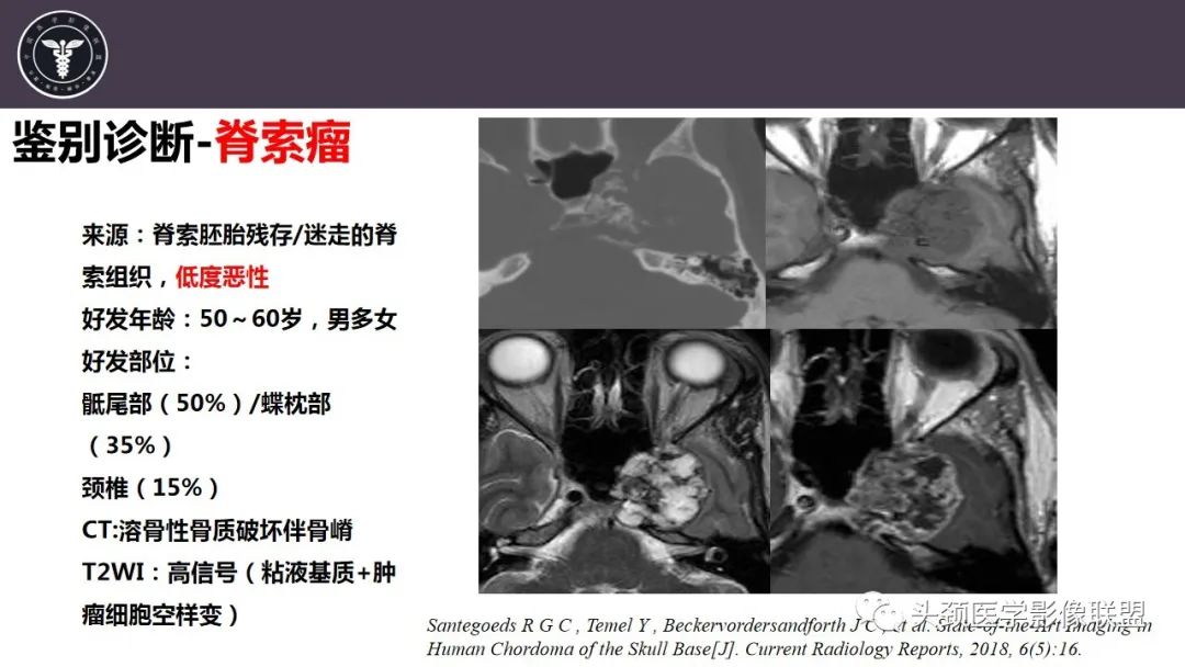 【病例】咬肌间隙肌纤维母细胞肉瘤1例MR诊断与鉴别-26