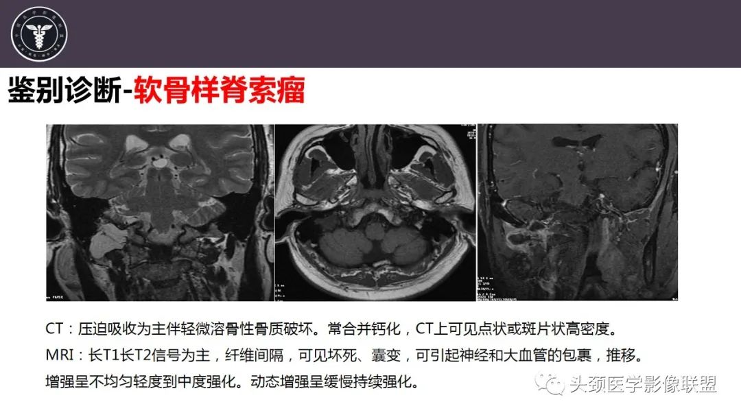 【病例】咬肌间隙肌纤维母细胞肉瘤1例MR诊断与鉴别-27