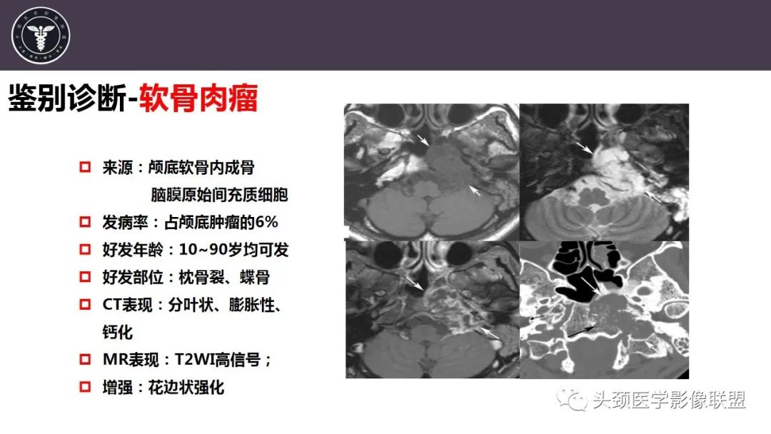 【病例】咬肌间隙肌纤维母细胞肉瘤1例MR诊断与鉴别-28