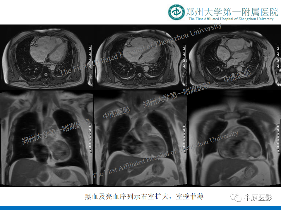 【病例】致心律失常性右室心肌病1例MR影像-5