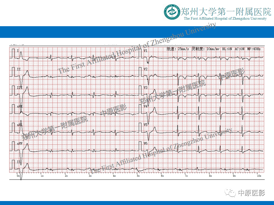 【病例】致心律失常性右室心肌病1例MR影像-4