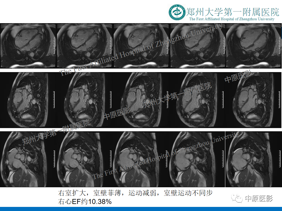 【病例】致心律失常性右室心肌病1例MR影像-6