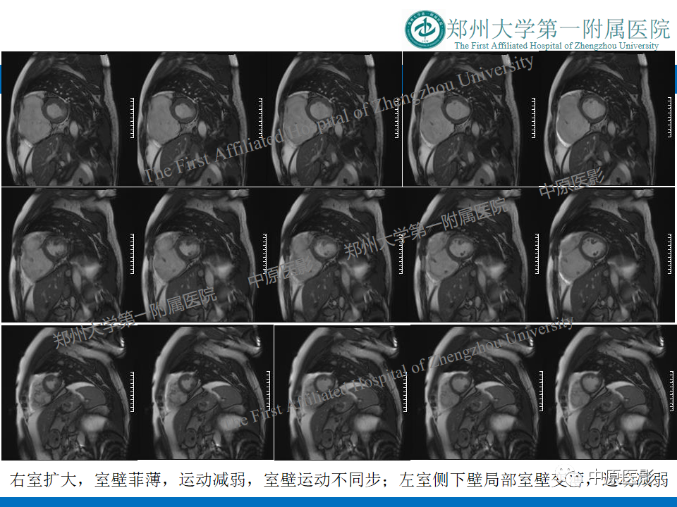 【病例】致心律失常性右室心肌病1例MR影像-7