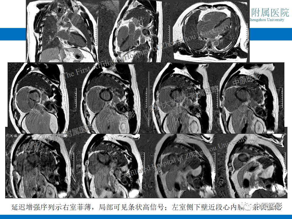 【病例】致心律失常性右室心肌病1例MR影像-8