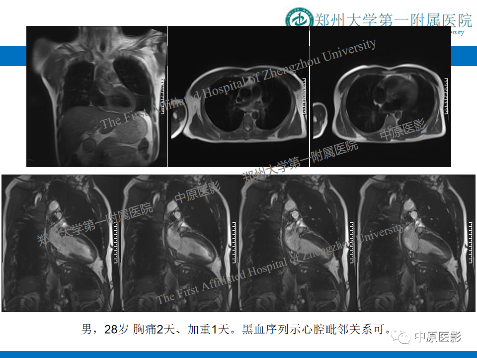 【病例】致心律失常性右室心肌病1例MR影像-18