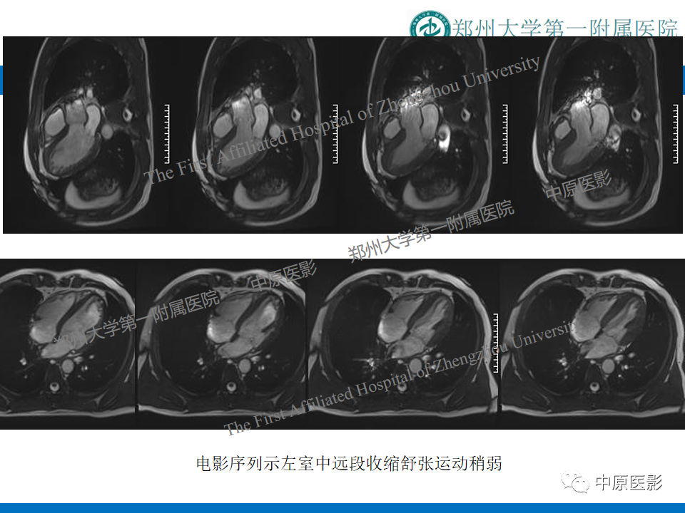 【病例】致心律失常性右室心肌病1例MR影像-19