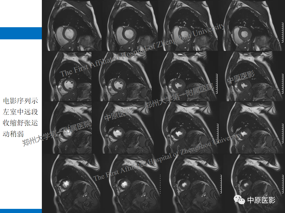 【病例】致心律失常性右室心肌病1例MR影像-20