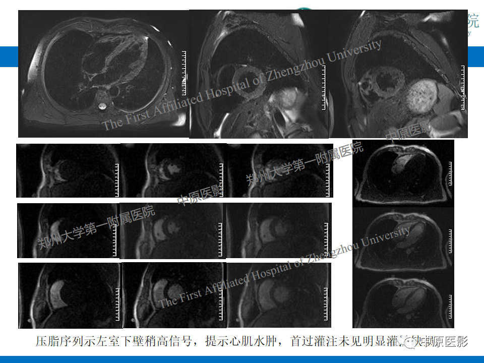 【病例】致心律失常性右室心肌病1例MR影像-21