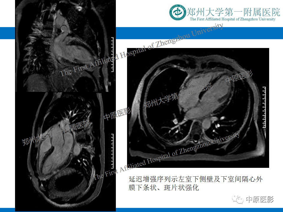 【病例】致心律失常性右室心肌病1例MR影像-23