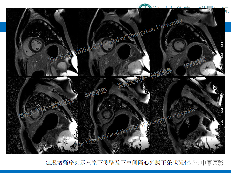 【病例】致心律失常性右室心肌病1例MR影像-22