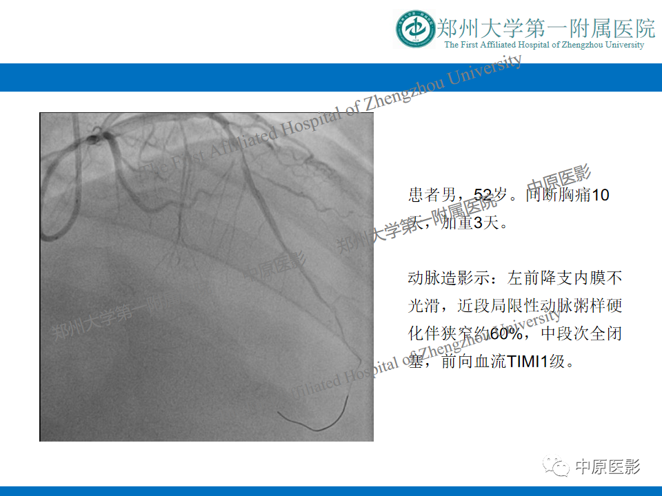 【病例】致心律失常性右室心肌病1例MR影像-25