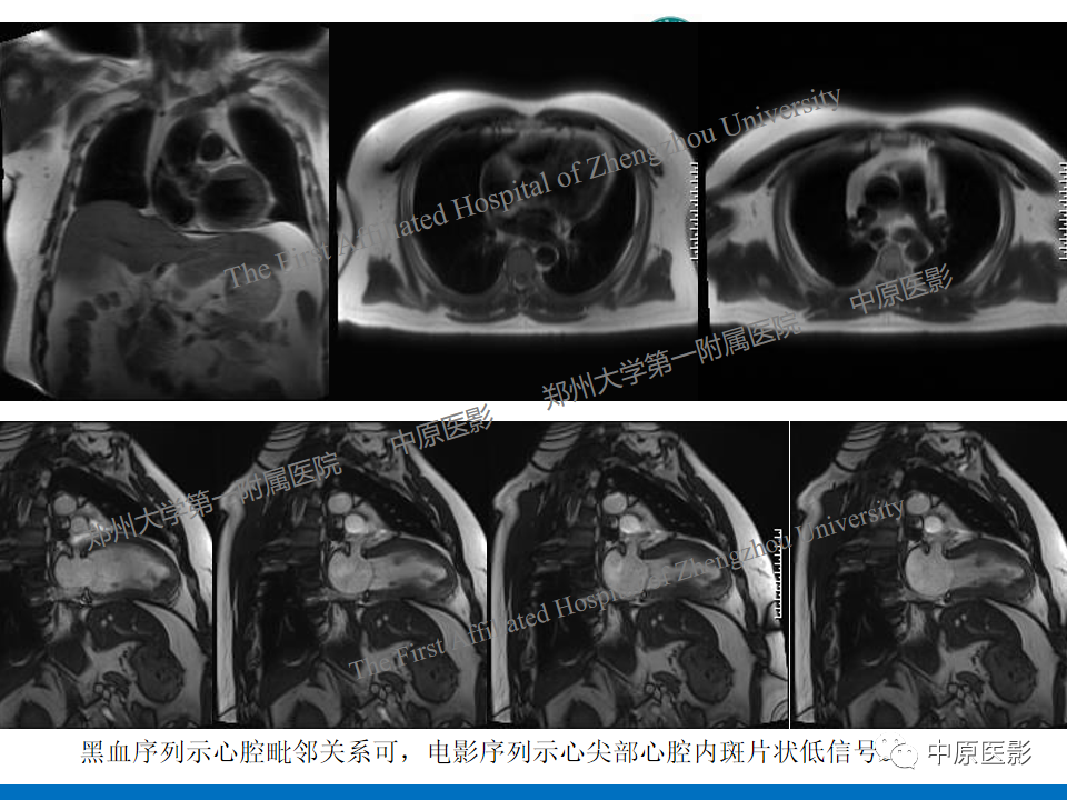 【病例】致心律失常性右室心肌病1例MR影像-26