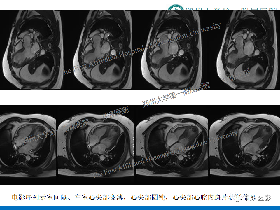 【病例】致心律失常性右室心肌病1例MR影像-27