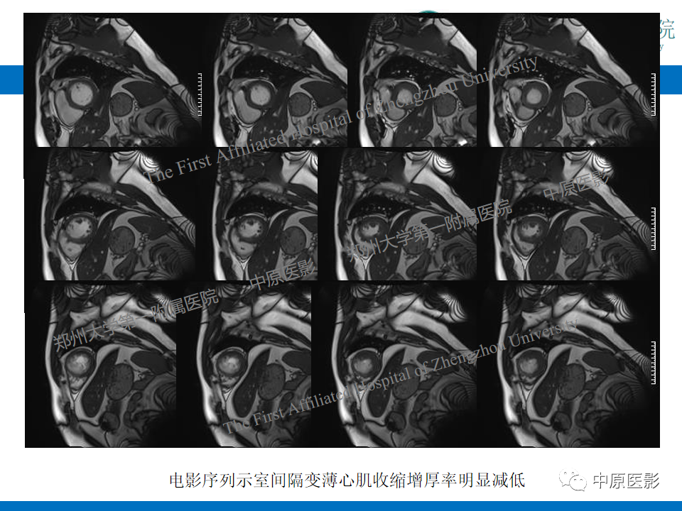 【病例】致心律失常性右室心肌病1例MR影像-28
