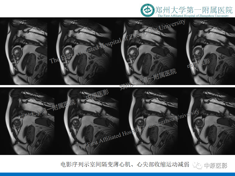 【病例】致心律失常性右室心肌病1例MR影像-29