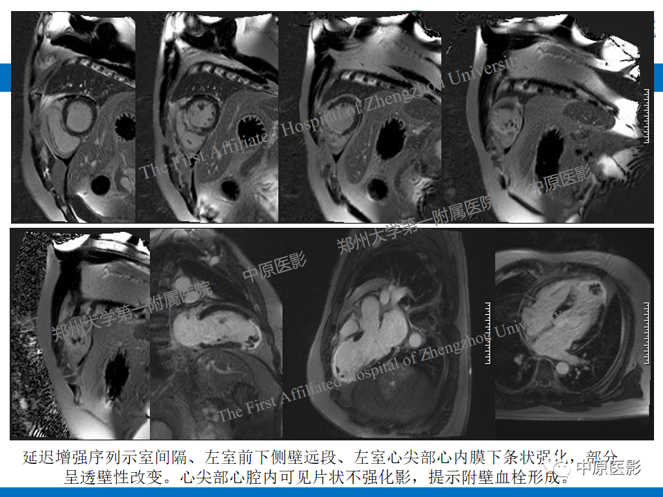 【病例】致心律失常性右室心肌病1例MR影像-31